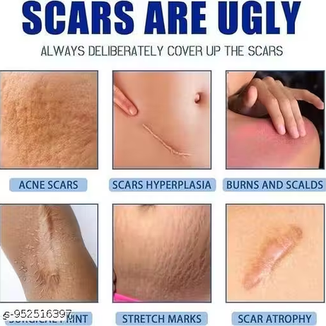 Scar Removal Cream & Gel | Advanced Scar Treatment for Old & New Scars, Keloids & Stretch Marks | Fast-Absorbing Scar Repair Gel for Face & Body